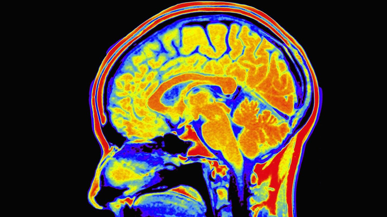 Side scan of the brain showing effect of sleep deprivation | Scooms